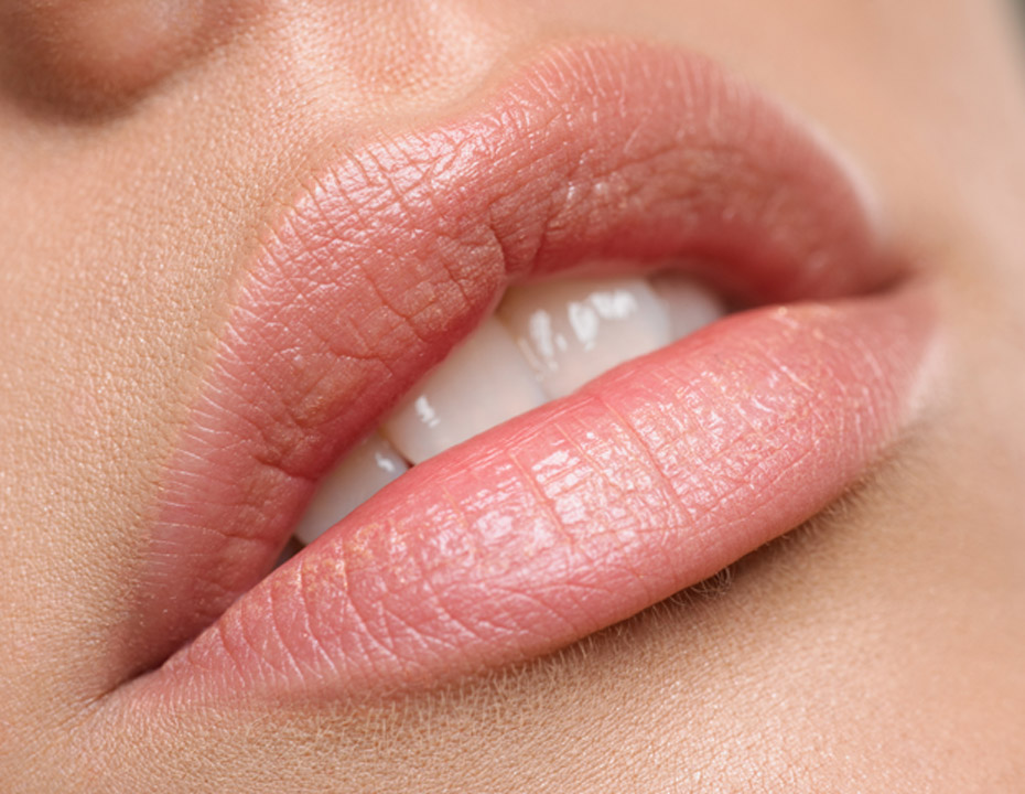 close-up-of-lips-after-injection-with-juvederm-volbella-xc