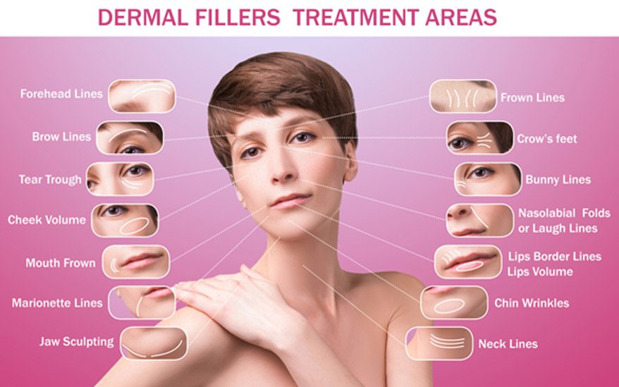 illustration-of-types-of-wrinkles-treated-by-dermal-fillers-such-as-botox