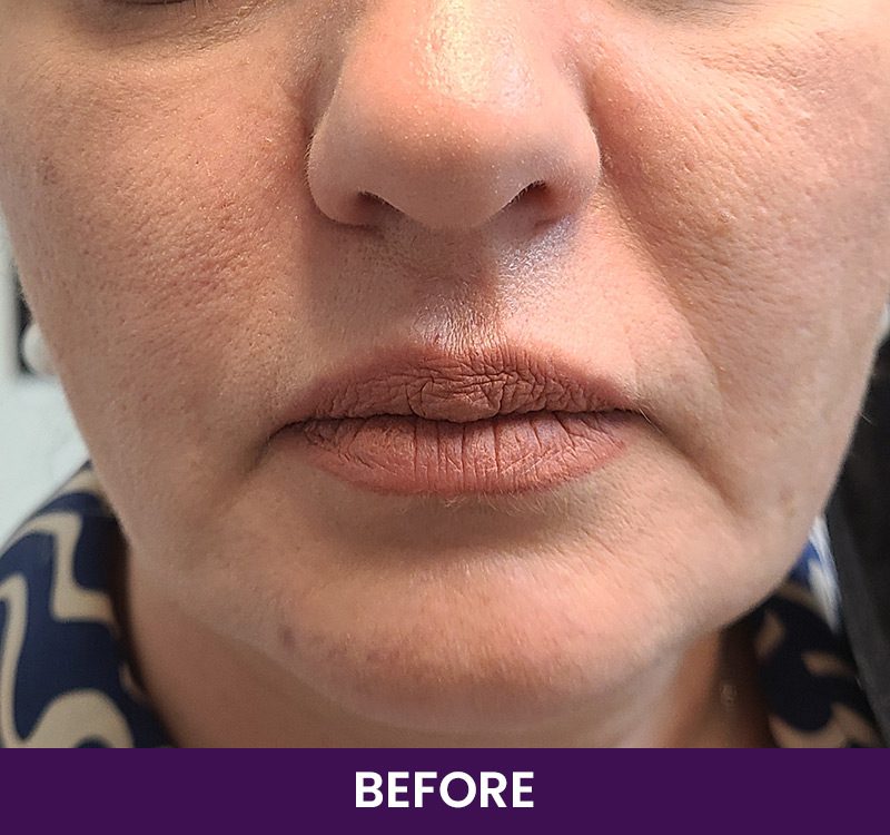 before-1ml-of-restylane-defyne before-1ml-of-restylane-defyne